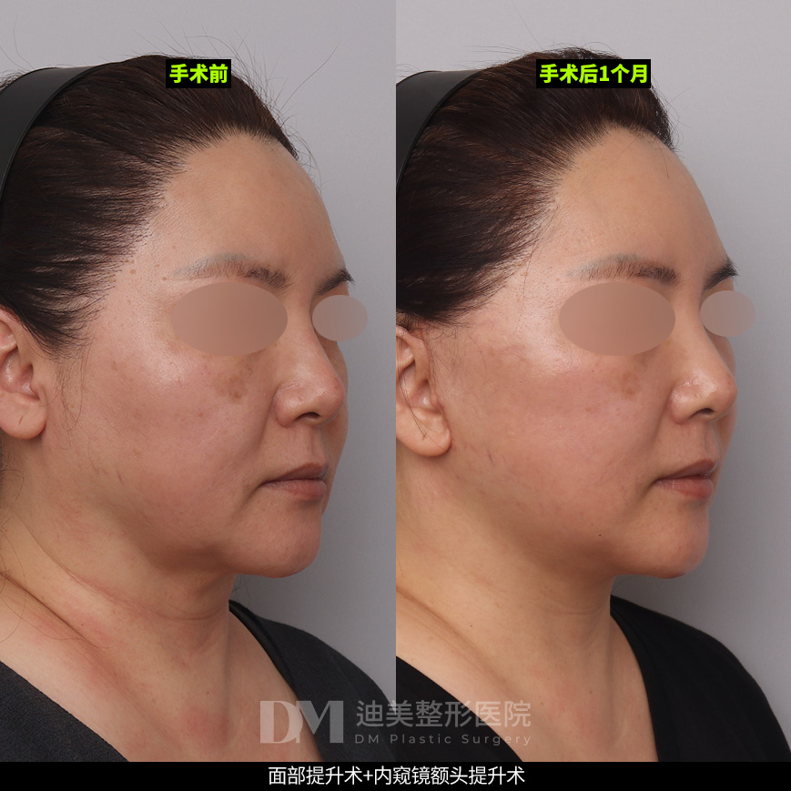 /images/cn/Anti_FullFace/Anti_FullFaceBA02.jpg