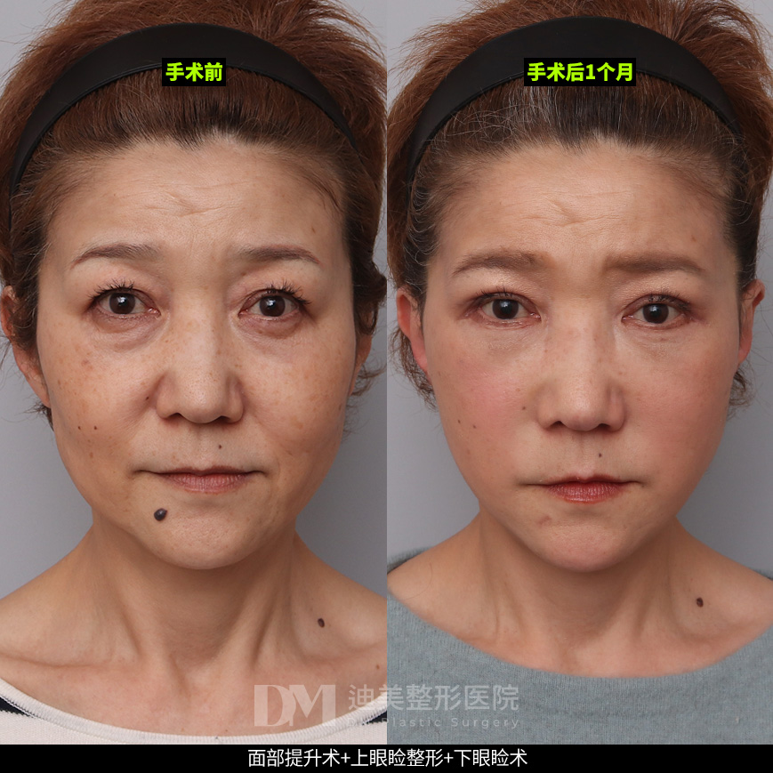 /images/cn/Anti_FullFace/Anti_FullFaceBA03.jpg