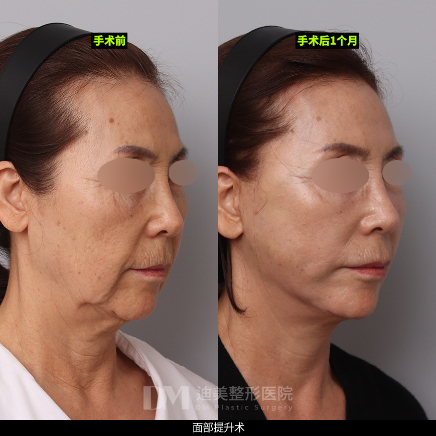 /images/cn/Anti_FullFace/Anti_FullFaceBA07.jpg