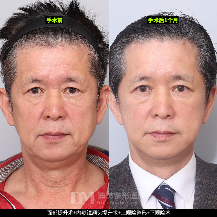 /images/cn/Anti_FullFace/Anti_FullFaceBA08.jpg