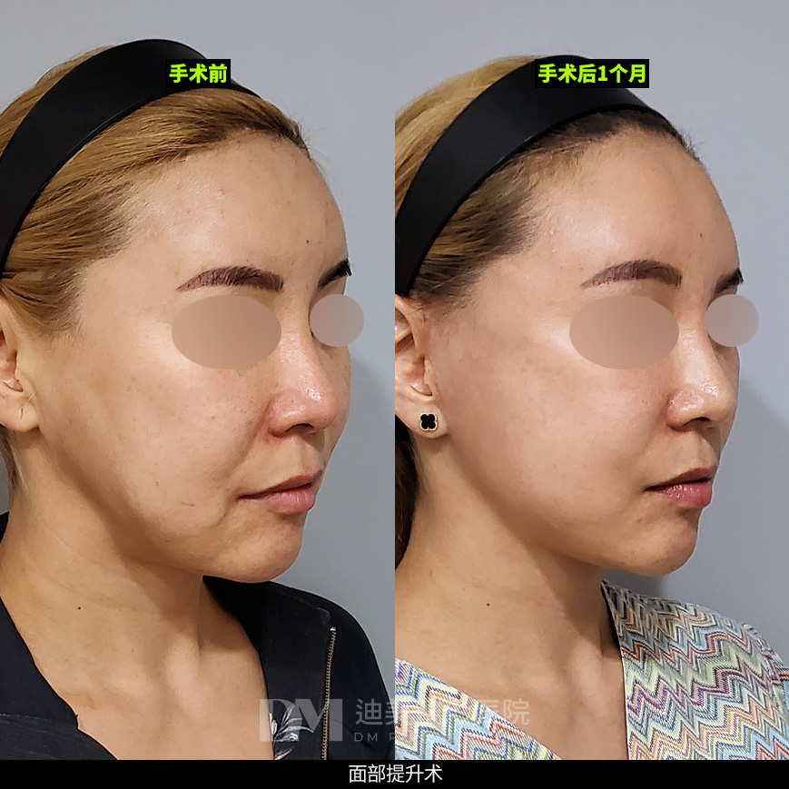 /images/cn/Anti_FullFace/Anti_FullFaceBA09.jpg