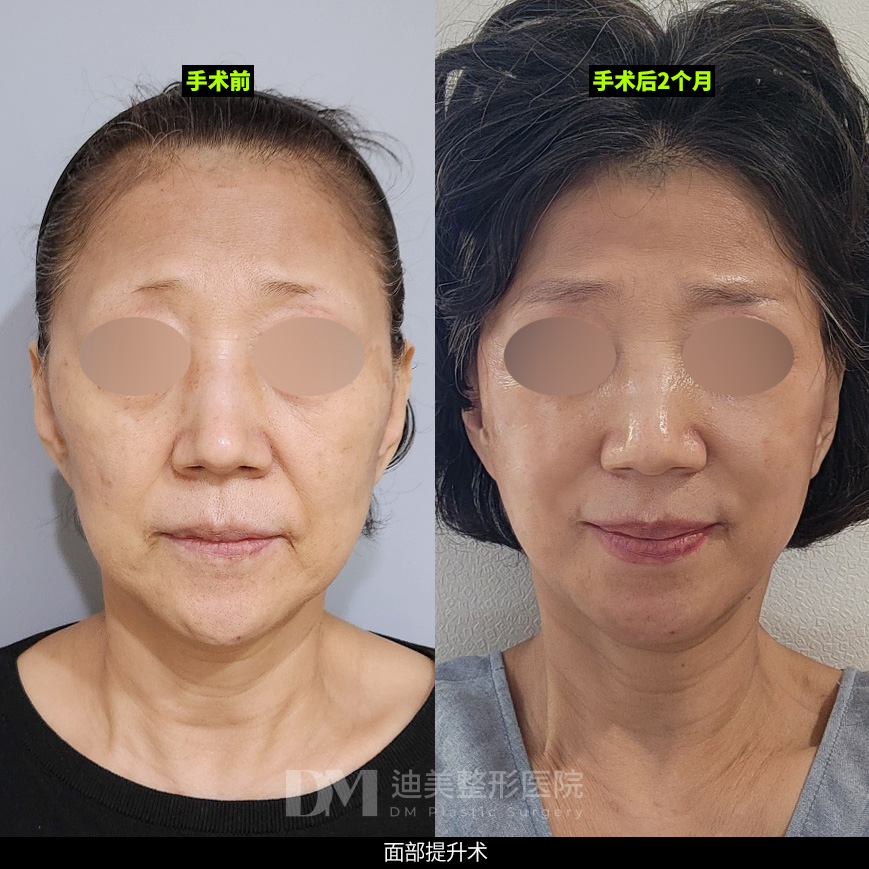 /images/cn/Anti_FullFace/Anti_FullFaceBA10.jpg