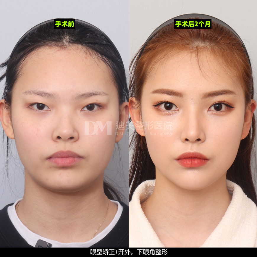 /images/cn/Eyes_EyesSurgery/Eyes_EyesSurgeryBA02.jpg