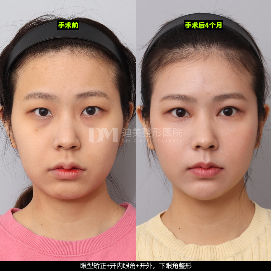 /images/cn/Eyes_EyesSurgery/Eyes_EyesSurgeryBA03.jpg