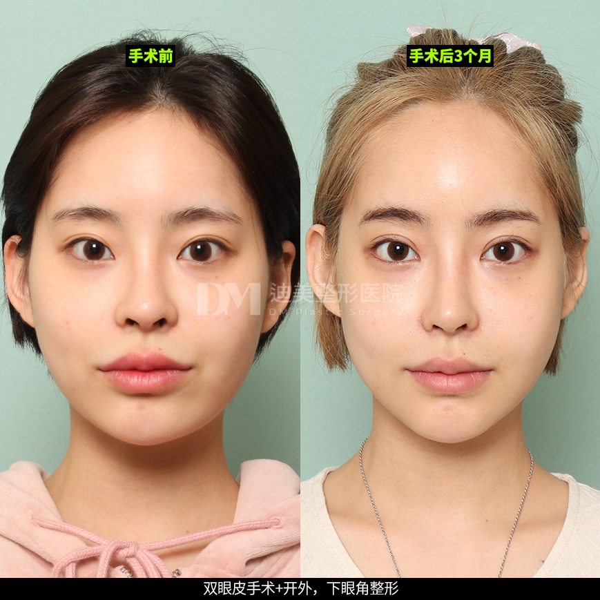 /images/cn/Eyes_EyesSurgery/Eyes_EyesSurgeryBA04.jpg