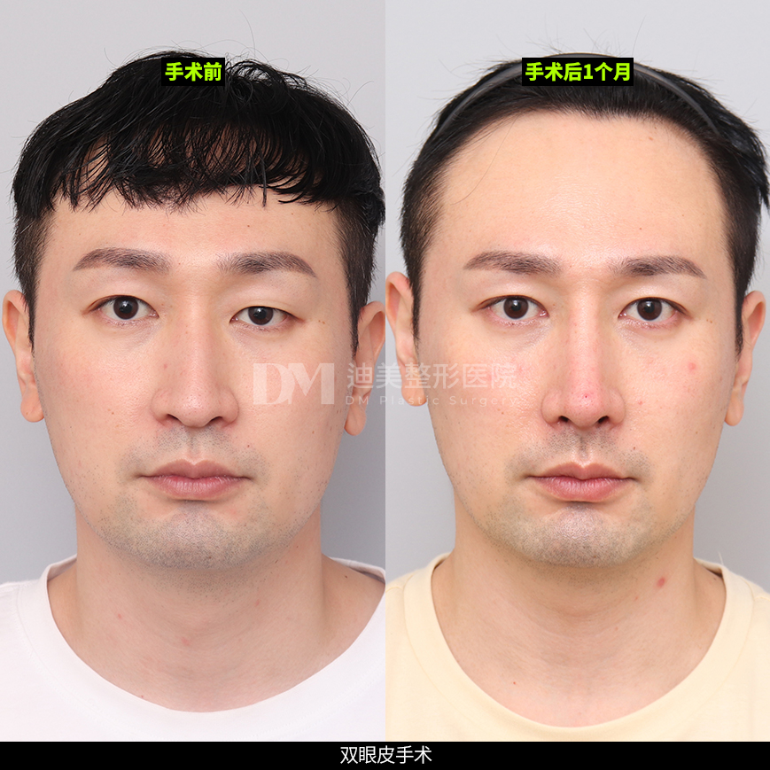 /images/cn/Eyes_EyesSurgery/Eyes_EyesSurgeryBA05.jpg