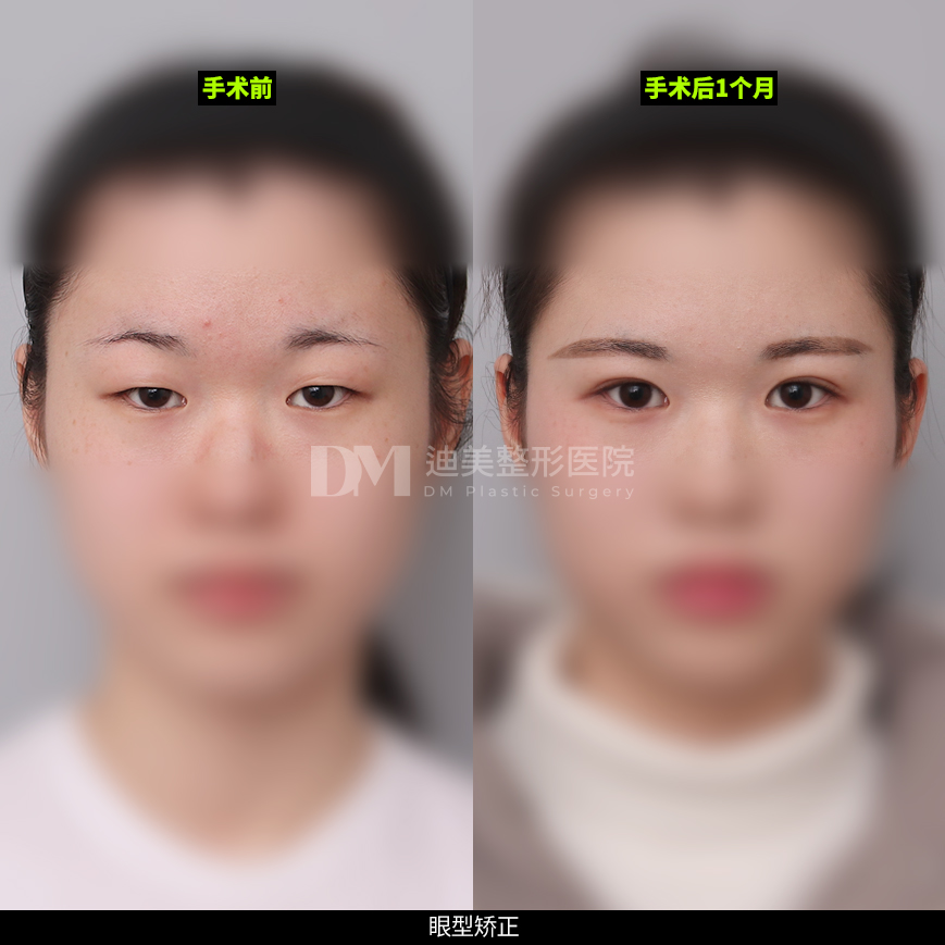/images/cn/Eyes_EyesSurgery/Eyes_EyesSurgeryBA06.jpg