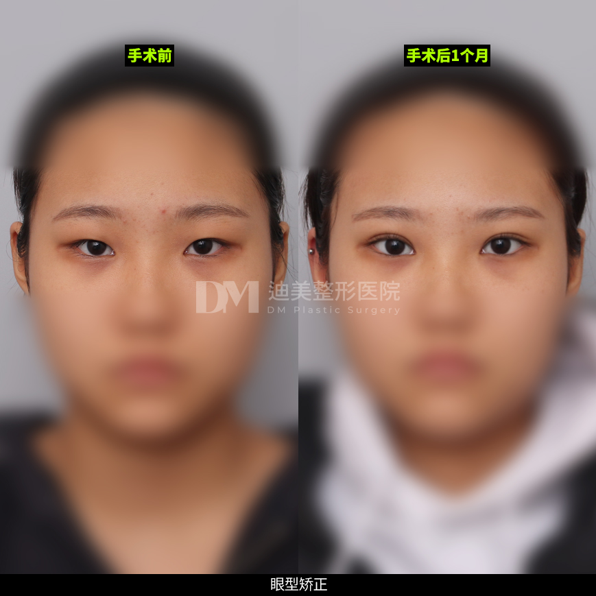 /images/cn/Eyes_EyesSurgery/Eyes_EyesSurgeryBA07.jpg