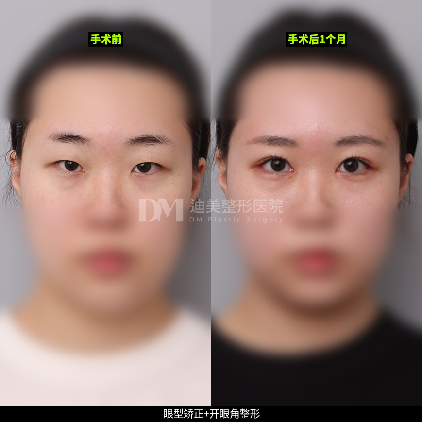 /images/cn/Eyes_EyesSurgery/Eyes_EyesSurgeryBA08.jpg
