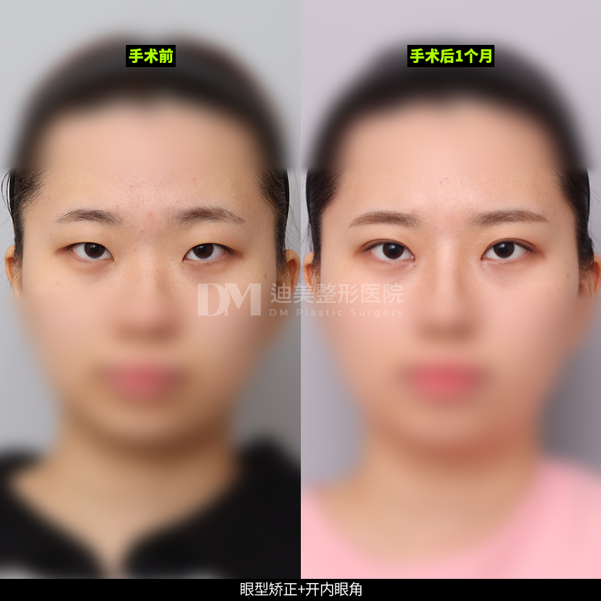 /images/cn/Eyes_EyesSurgery/Eyes_EyesSurgeryBA09.jpg
