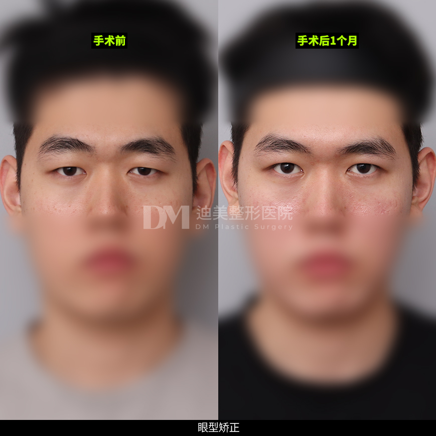 /images/cn/Eyes_EyesSurgery/Eyes_EyesSurgeryBA10.jpg