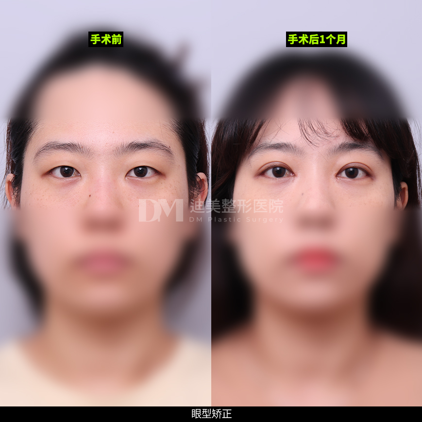 /images/cn/Eyes_EyesSurgery/Eyes_EyesSurgeryBA11.jpg