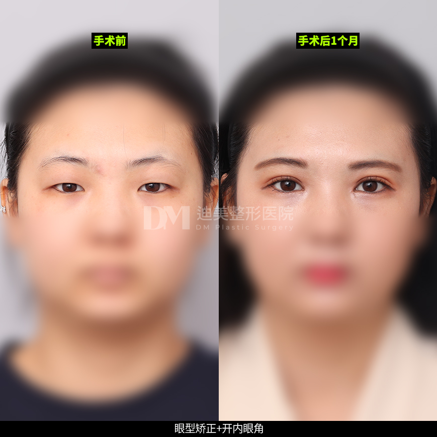 /images/cn/Eyes_EyesSurgery/Eyes_EyesSurgeryBA12.jpg