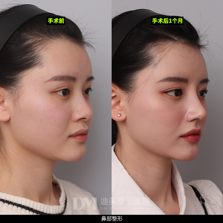 /images/cn/Nose_Bulbous/Nose_BulbousBA02.jpg