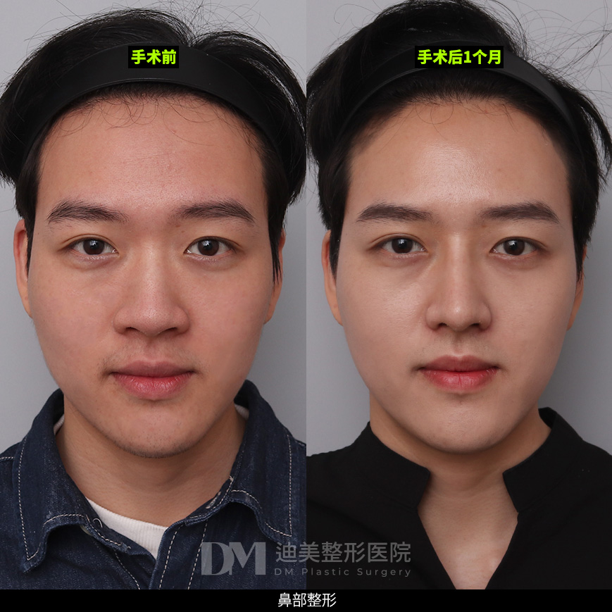 /images/cn/Nose_Bulbous/Nose_BulbousBA03.jpg