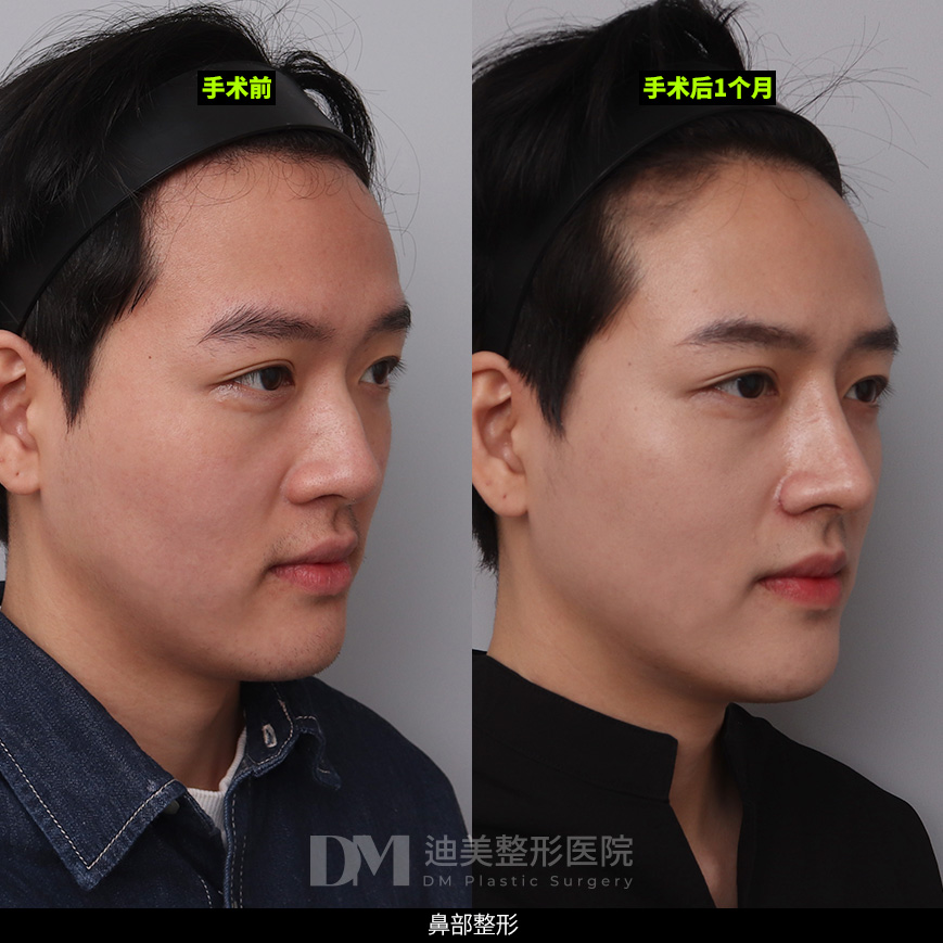 /images/cn/Nose_Bulbous/Nose_BulbousBA04.jpg