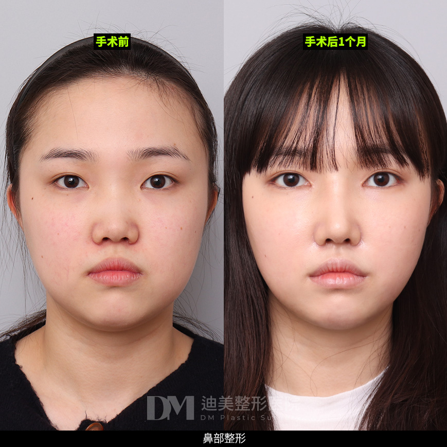 /images/cn/Nose_Bulbous/Nose_BulbousBA05.jpg