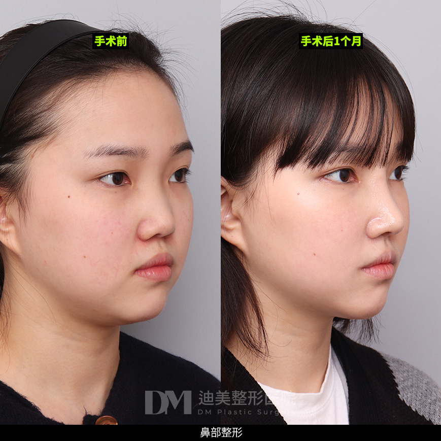 /images/cn/Nose_Bulbous/Nose_BulbousBA06.jpg