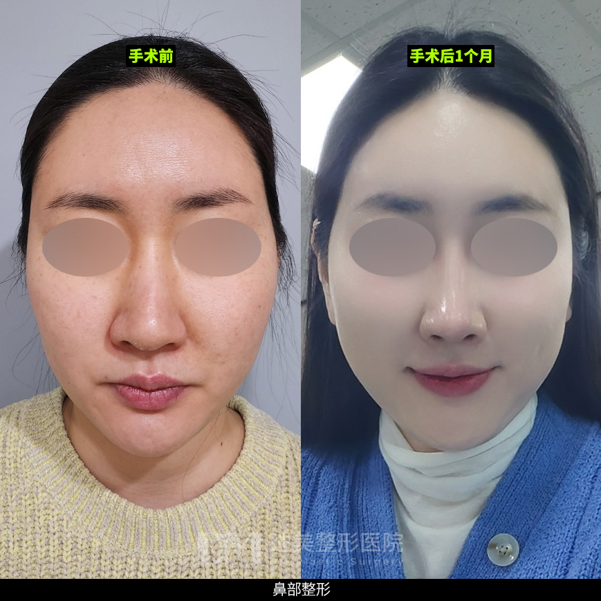 /images/cn/Nose_Bulbous/Nose_BulbousBA07.jpg