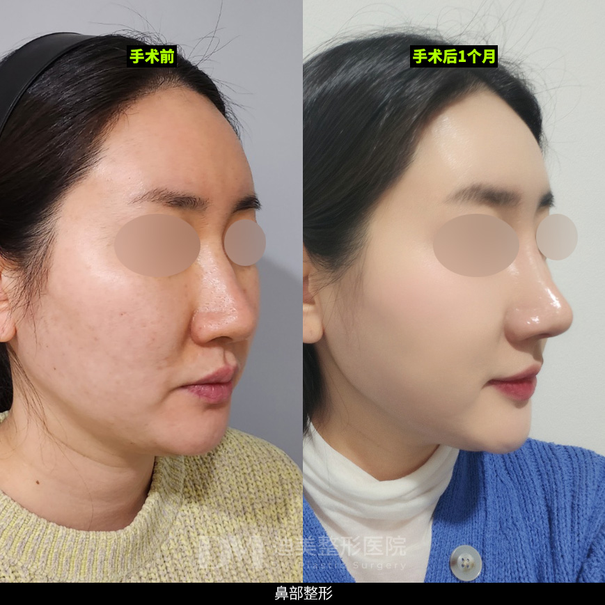 /images/cn/Nose_Bulbous/Nose_BulbousBA08.jpg