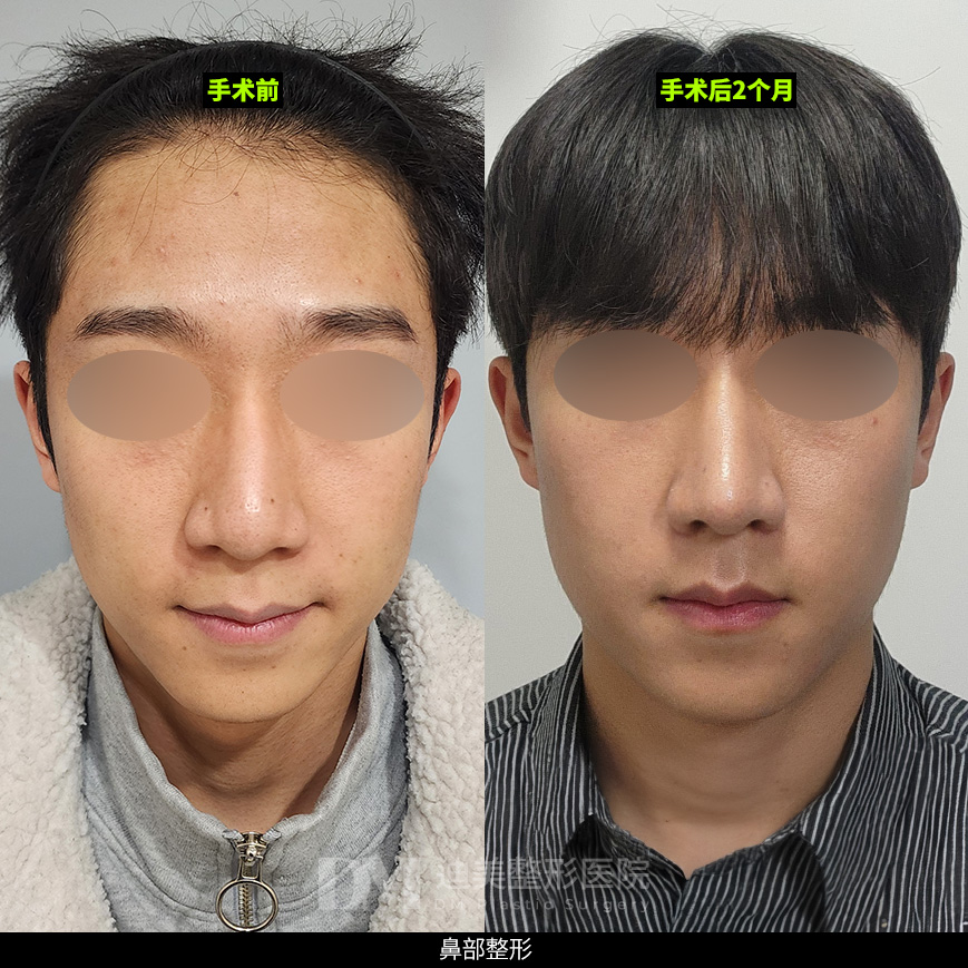 /images/cn/Nose_Bulbous/Nose_BulbousBA09.jpg