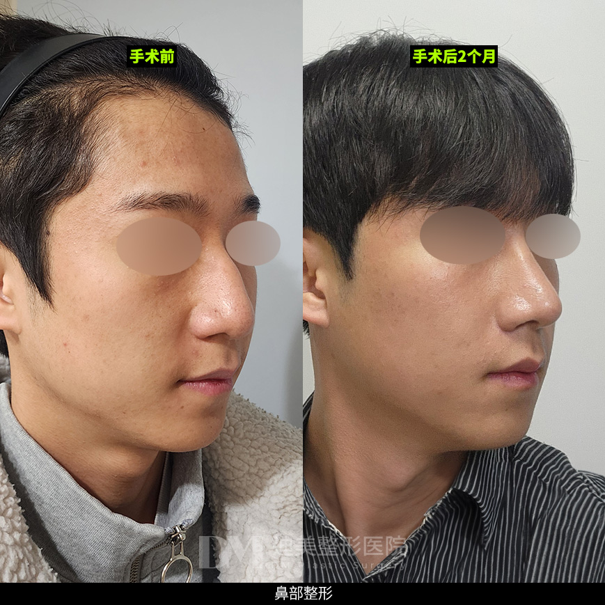 /images/cn/Nose_Bulbous/Nose_BulbousBA10.jpg
