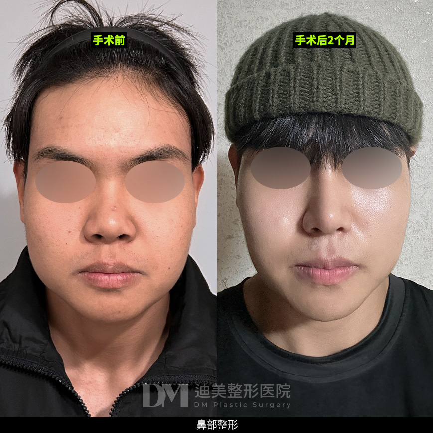 /images/cn/Nose_Bulbous/Nose_BulbousBA11.jpg