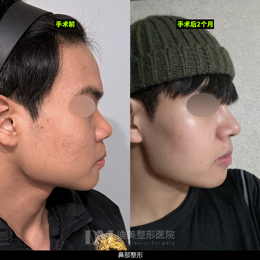 /images/cn/Nose_Bulbous/Nose_BulbousBA12.jpg